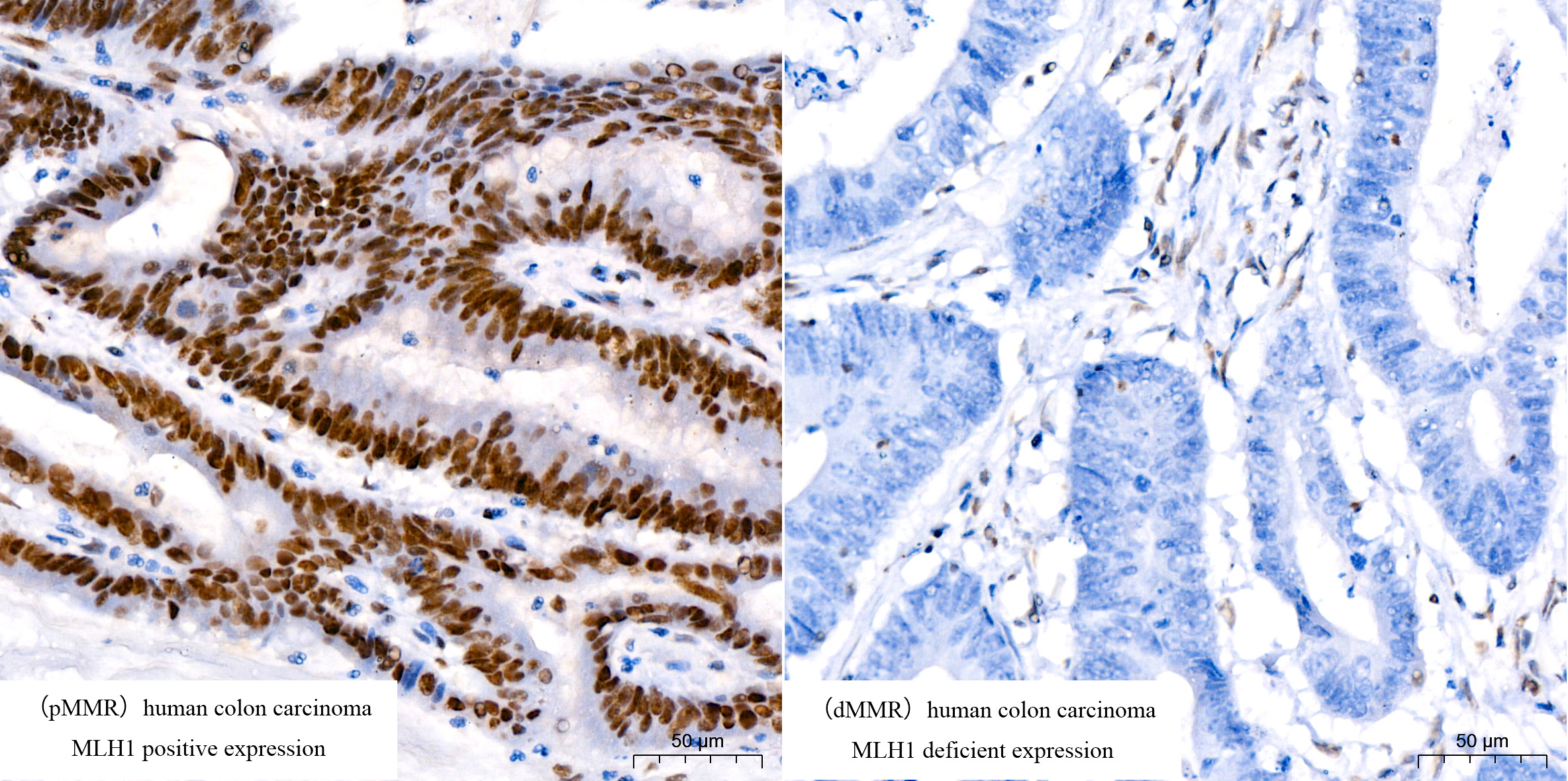 MLH1抗体试剂（免疫组织化学）